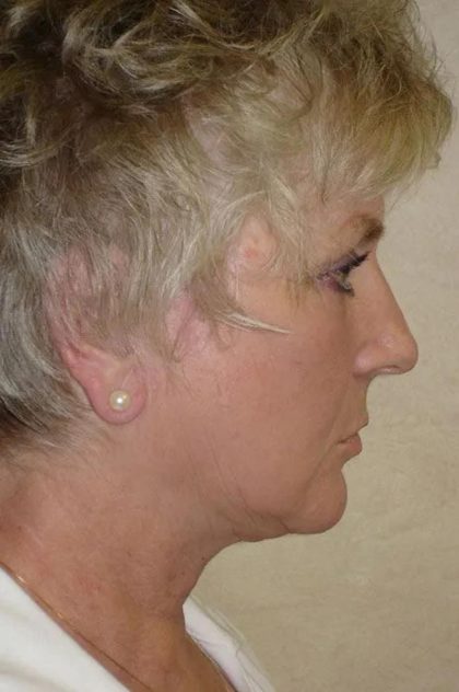 Facelift Before & After Patient #1710