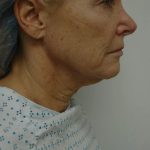 Facelift Before & After Patient #1711