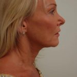 Facelift Before & After Patient #1711