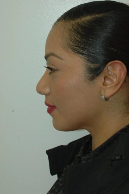 Rhinoplasty Before & After Patient #1729