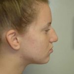 Rhinoplasty Before & After Patient #1730