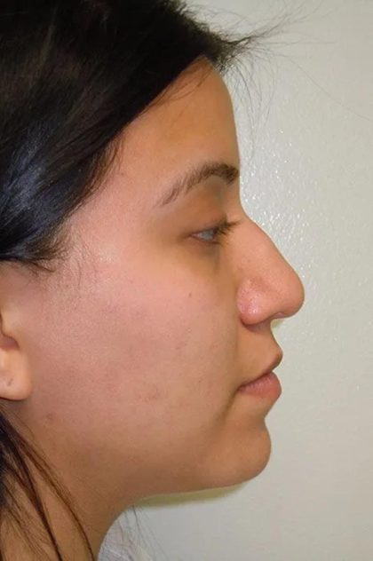 Rhinoplasty Before & After Patient #1731