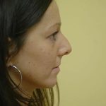 Rhinoplasty Before & After Patient #1732