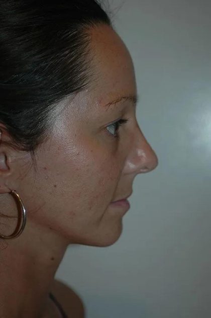 Rhinoplasty Before & After Patient #1732