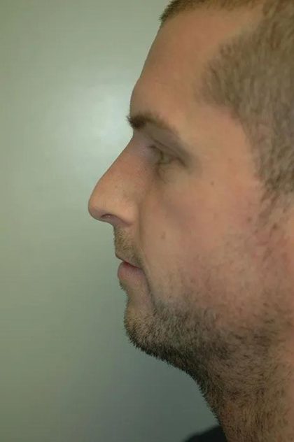 Rhinoplasty Before & After Patient #1733