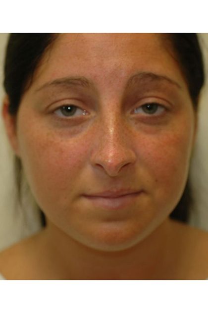 Rhinoplasty Before & After Patient #1735