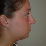 Rhinoplasty Before & After Patient #1735
