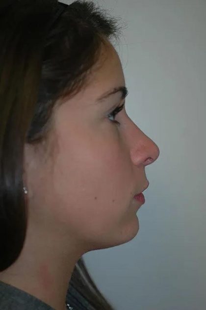Rhinoplasty Before & After Patient #1736