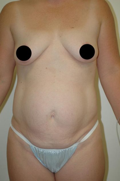 Tummy Tuck Before & After Patient #1856