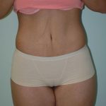 Tummy Tuck Before & After Patient #1858