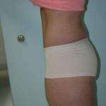 Tummy Tuck Before & After Patient #1858