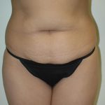 Tummy Tuck Before & After Patient #1859