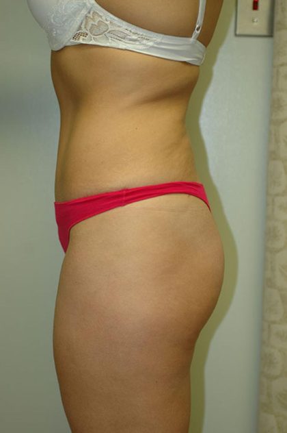 Tummy Tuck Before & After Patient #1859