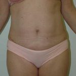 Tummy Tuck Before & After Patient #1860