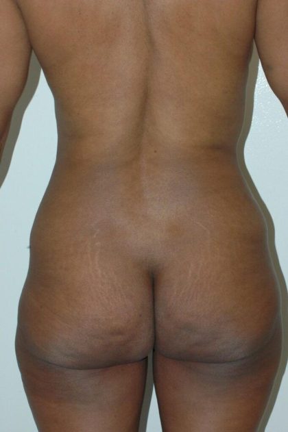 Tummy Tuck Before & After Patient #1847