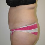 Tummy Tuck Before & After Patient #1848