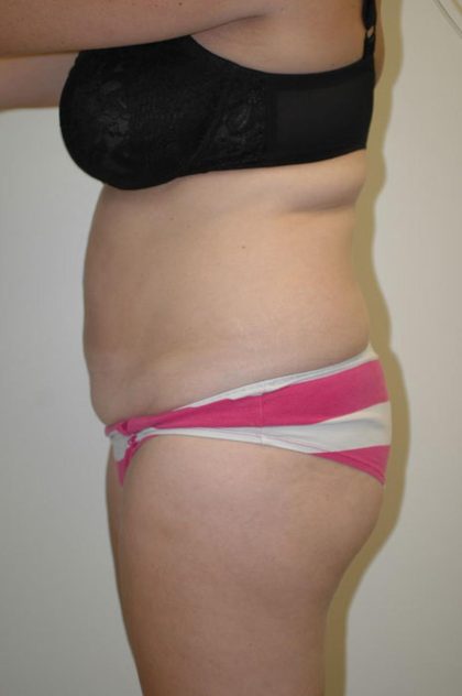 Tummy Tuck Before & After Patient #1848