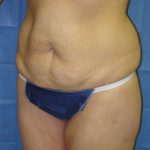Tummy Tuck Before & After Patient #1849