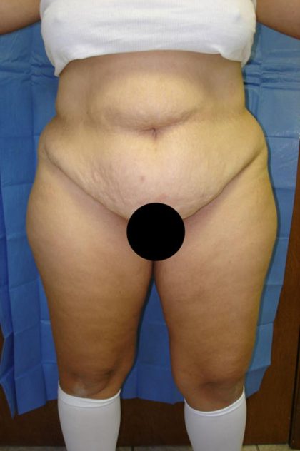 Tummy Tuck Before & After Patient #1850