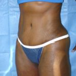 Tummy Tuck Before & After Patient #1851