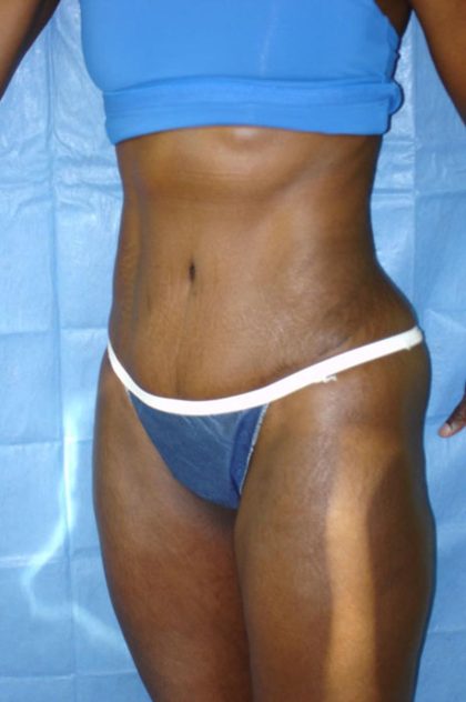 Tummy Tuck Before & After Patient #1851