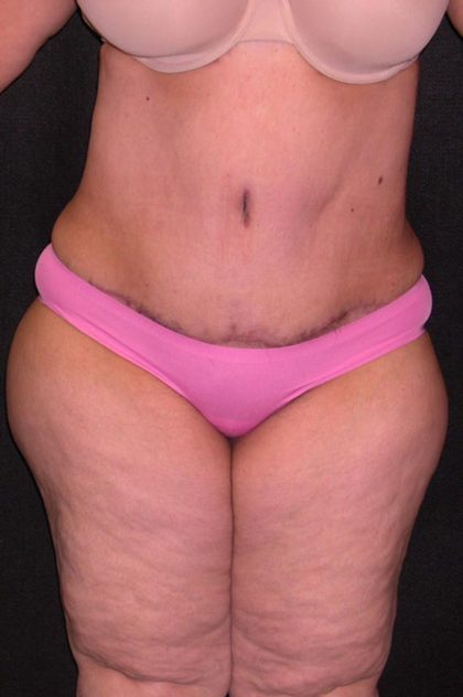 Tummy Tuck Before & After Patient #1852