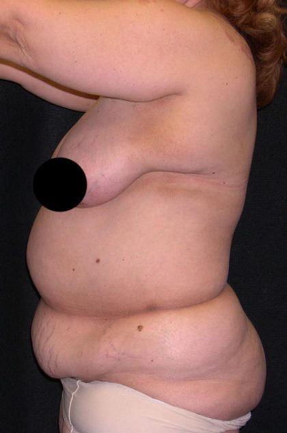 Tummy Tuck Before & After Patient #1852
