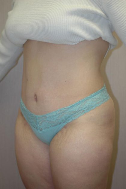 Tummy Tuck Before & After Patient #1853