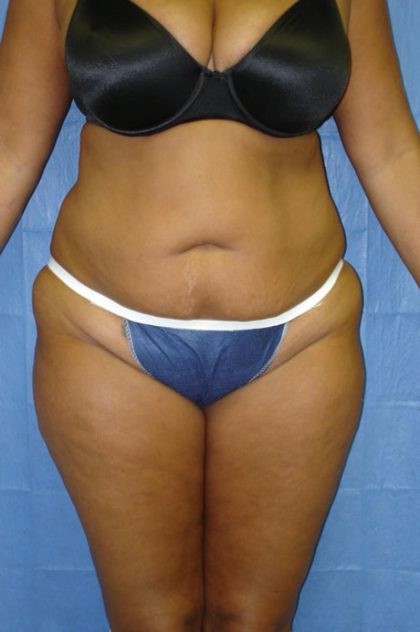Tummy Tuck Before & After Patient #1854