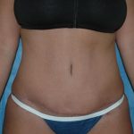 Tummy Tuck Before & After Patient #1854