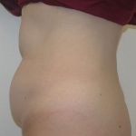 Tummy Tuck Before & After Patient #1855