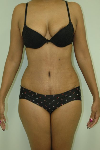 Abdominplasty Before & After Patient #2052