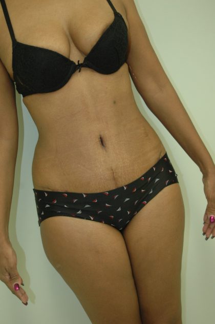 Abdominplasty Before & After Patient #2052