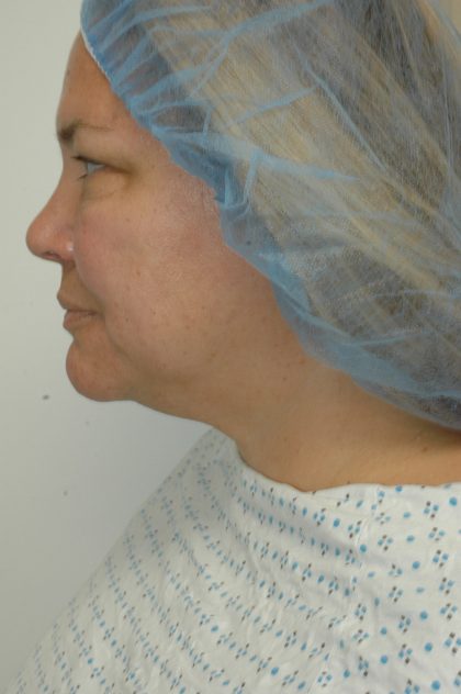 Liposuction of Neck/Chin Before & After Patient #2077