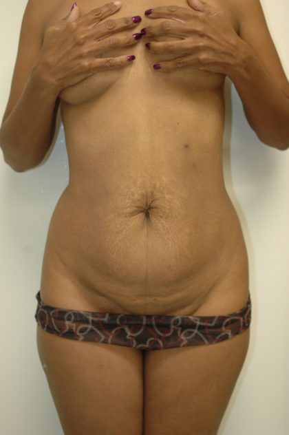 Abdominplasty Before & After Patient #2052