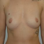 Breast Augmentation Before & After Patient #2059