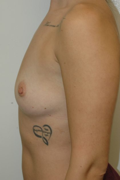 Breast Augmentation Before & After Patient #2059