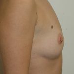 Breast Augmentation Before & After Patient #2059