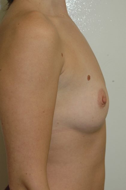 Breast Augmentation Before & After Patient #2059