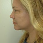 Liposuction of Neck/Chin Before & After Patient #2077