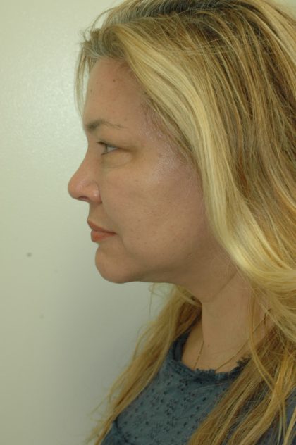 Liposuction of Neck/Chin Before & After Patient #2077