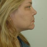 Liposuction of Neck/Chin Before & After Patient #2077