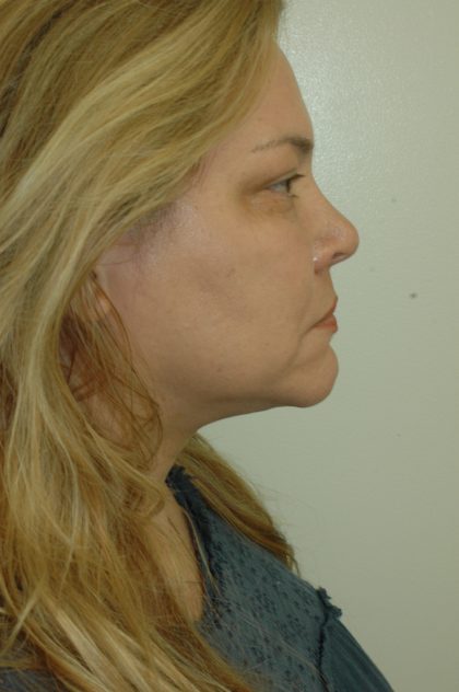 Liposuction of Neck/Chin Before & After Patient #2077