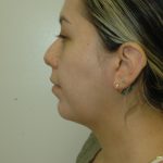 Liposuction of Neck/Chin Before & After Patient #2050