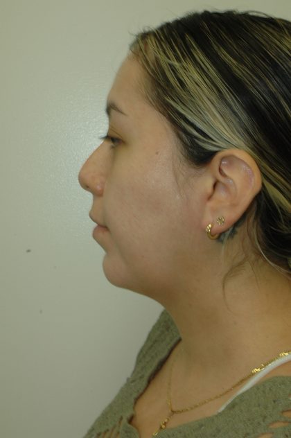 Liposuction of Neck/Chin Before & After Patient #2050