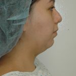 Liposuction of Neck/Chin Before & After Patient #2050