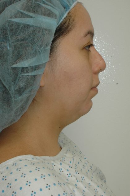 Liposuction of Neck/Chin Before & After Patient #2050