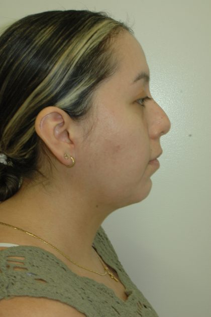 Liposuction of Neck/Chin Before & After Patient #2050