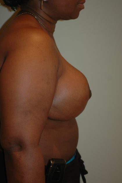 Breast Reduction Before & After Patient #2129