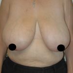 Vertical Breast Reduction Before & After Patient #2136